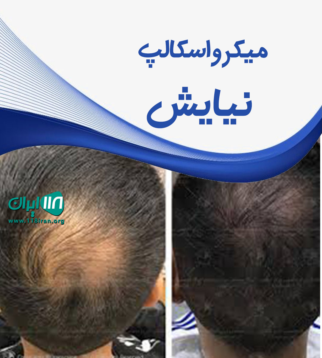 میکرو اسکالپ نیایش در تهران