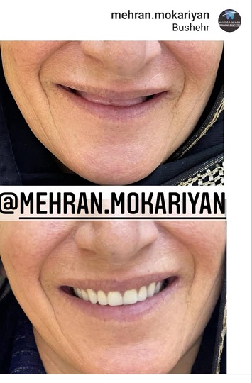 دندانسازی مکاریان در بوشهر دندانسازی مکاریان در بوشهر