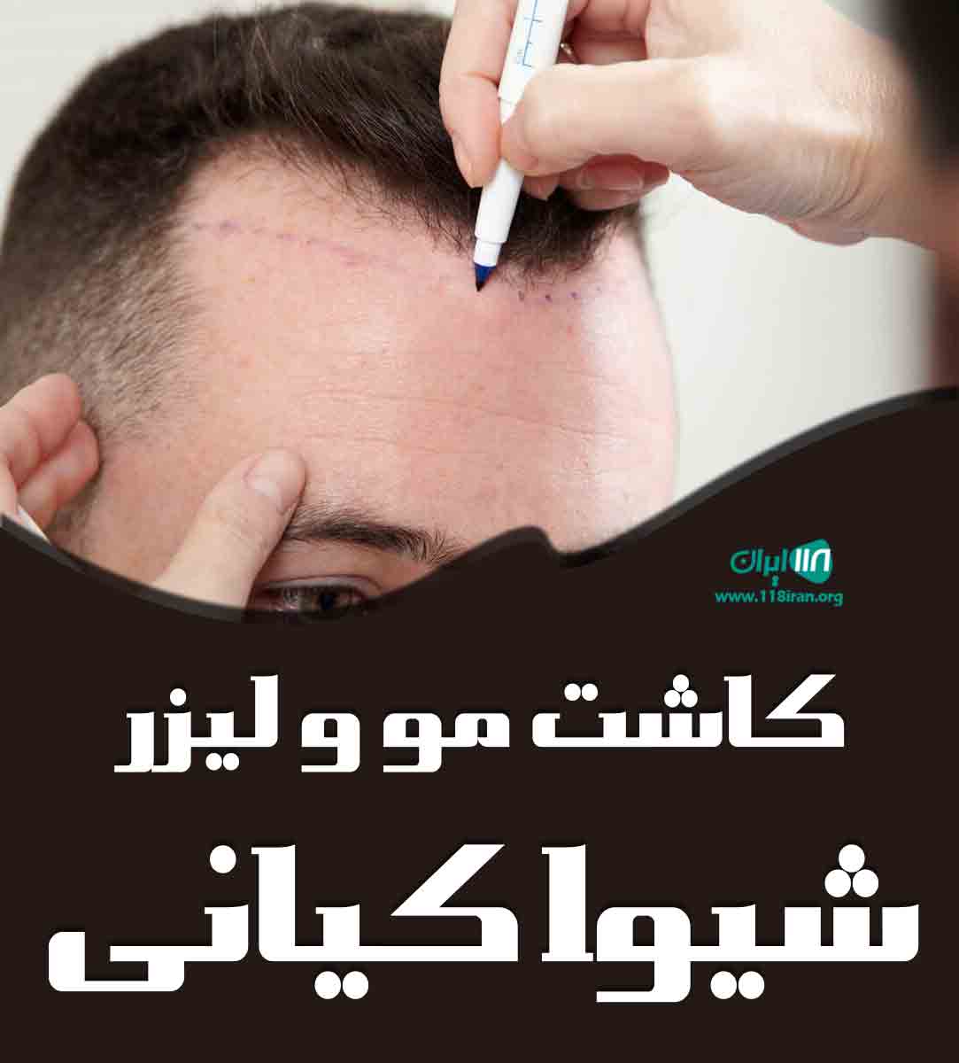 کاشت مو و لیزر شیوا کیانی در اهواز
