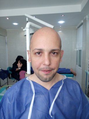 کلینیک کاشت مو دکتر شبان در بیرجند