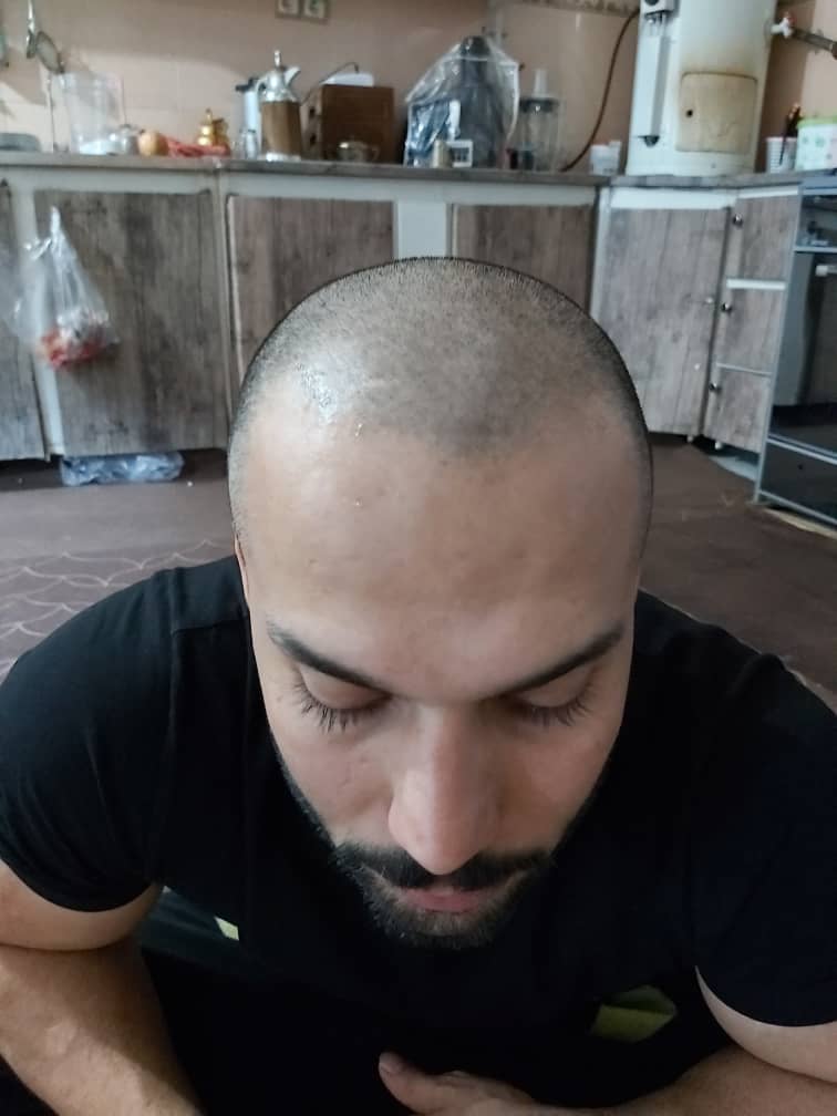 کلینیک کاشت مو دکتر شبان در بیرجند