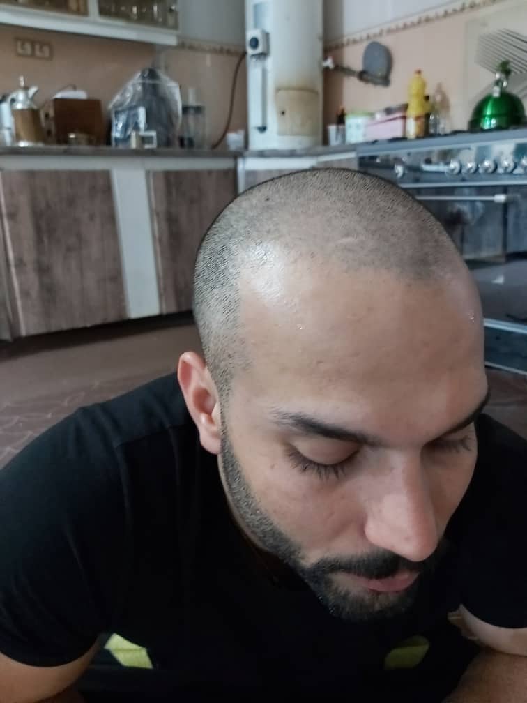 کلینیک کاشت مو دکتر شبان در بیرجند