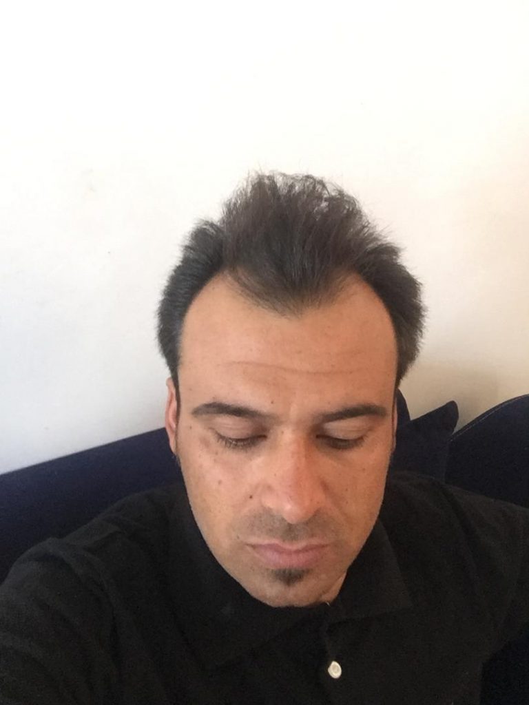 کلینیک کاشت مو دکتر شبان در بیرجند