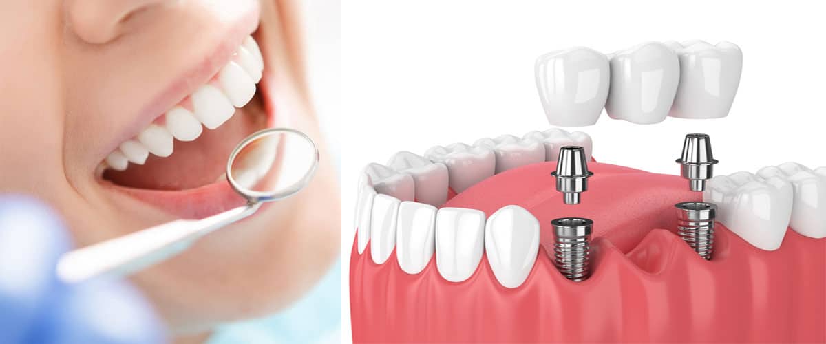 دندانسازی علیباشی در بجنورد کشانک دندانسازی علیباشی در بجنورد کشانک