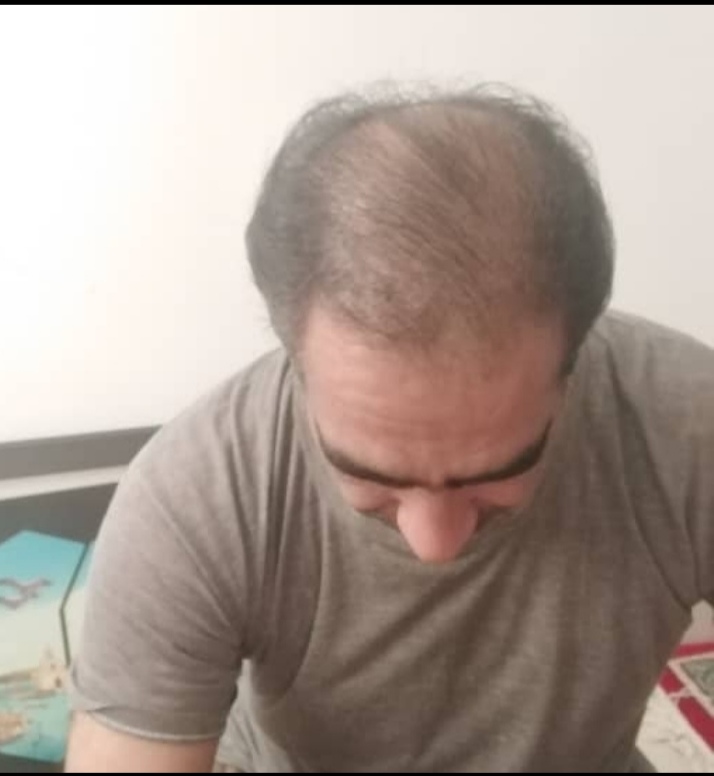 کلینیک کاشت مو دکتر شبان در بیرجند