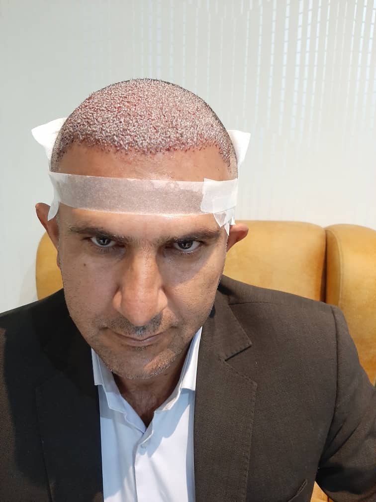 کلینیک کاشت مو دکتر شبان در بیرجند