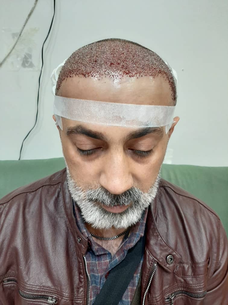 کلینیک کاشت مو دکتر شبان در بیرجند