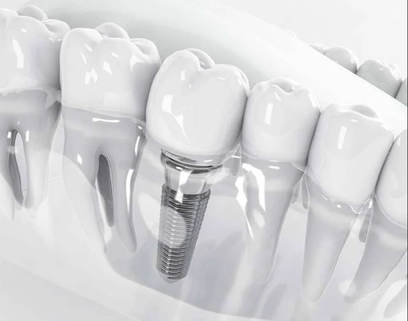 دندانسازی علیباشی در بجنورد کشانک دندانسازی علیباشی در بجنورد کشانک